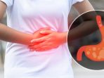 Cara Mengatasi Asam Lambung Secara Efektif